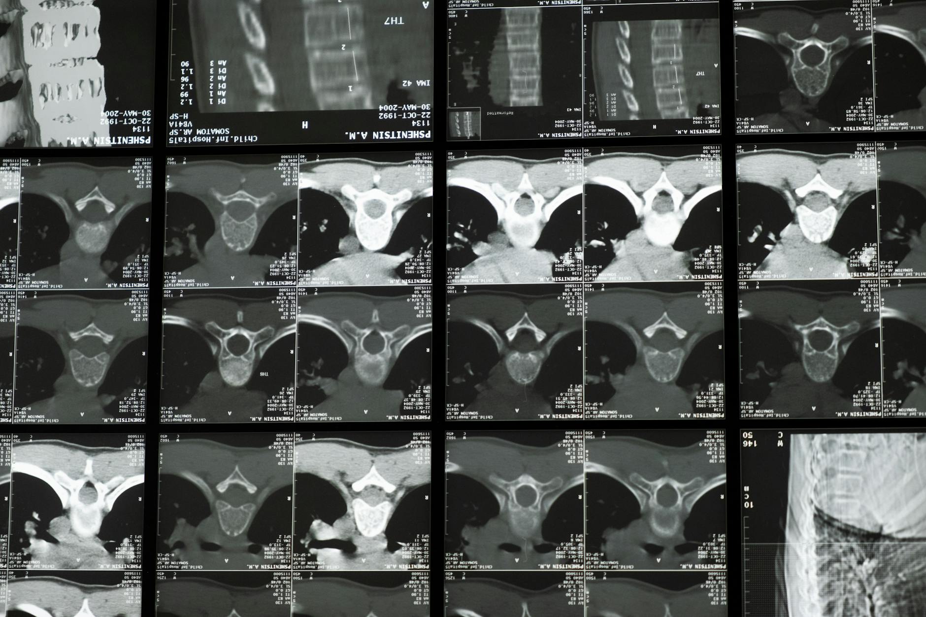 Radiologiczne zdjęcie kręgosłupa z wyraźnie widocznym odcinkiem piersiowym
